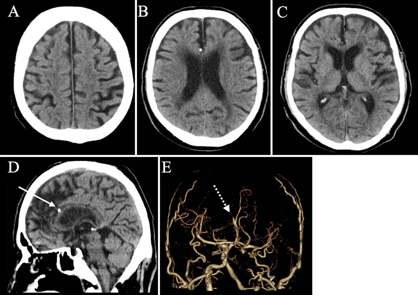 A–C: Plain CT scans obtained at admission showing no ischemic change. D: Sagittal slice of a plain CT scan obtained at admission showing a high-density spot (arrow) located directly superior to the body of the corpus callosum. E: CT angiogram showing a right A3 occlusion (dotted arrow) and a left ICA occlusion.